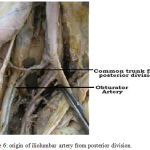 Figure 6: origin of iliolumbar artery from posterior division.