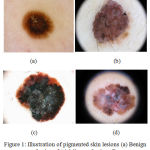 Figure 1: Illustration of pigmented skin lesions (a) Benign Lesions (b) Malignant Lesions.21