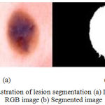 Figure 6: Illustration of lesion segmentation (a) Dermoscopic RGB image (b) Segmented image.