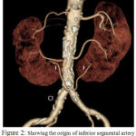 Figure 2: Showing the origin of inferior segmental artery from common iliac artery.