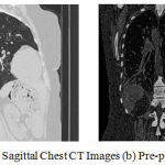 Figure 1: (a) Original Coronal and Sagittal Chest CT Images (b) Pre-processed image.