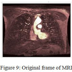 Figure 9: Original frame of MRI.