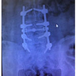 Figure 2: Postoperative Lumbar x-ray showing area of laminectomy and instrumentation.