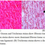 Figure 4: Verhoeff-van Gieson and Trichrome stains show fibrosis tissue and elastic fibers. (A) Verhoeff-van Gieson stains shows more dominant fibrous tissue compared to elastin connective tissue in flavum ligament. (B) Trichrome stains shows a decrease in the ratio of elastin tissue to fibrous tissue.