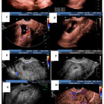 Figure 1: TV scan of case (no 6). Pre-treatment (A, B, C &D) & Post-treatment (E-day 1, F &G- day 10 & H-4 ).