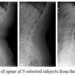 Figure 1: X-Ray scan images of spine of 5 selected subjects from the XSITRAY.