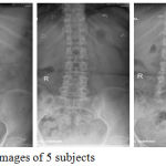 Figure 2: Sample X-Ray Femur images of 5 subjects​.