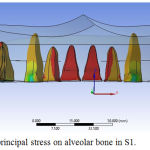 Figure 6: Minimum principal stress on alveolar bone in S1.