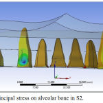 Figure 7: Minimum principal stress on alveolar bone in S2.