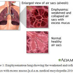Figure 1: Emphysematous lung showing the weakened and collapsed air sacs with excess mucus.[a.d.a.m. medical encyclopedia 2016].2