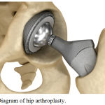 Figure 1: Diagram of hip arthroplasty.