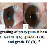 Figure 1: The grading of pterygium is based on extension to the cornea. Grade I(A), grade II (B), grade III (C), and grade IV (D).17