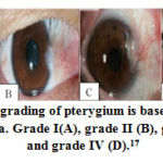 Histamine 1 Receptors Expression In Primary Pterygium Tissue Is Higher 