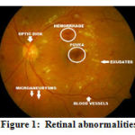 Figure 1: Retinal abnormalities