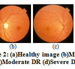 Figure 2: (a)Healthy image (b)Mild DR (c)Moderate DR (d)Severe DR