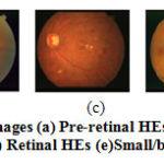 Figure 3: Types of hemorrhages (a) Pre-retinal HEs (b) Sub retinal HEs (c) dot HEs (d) Retinal HEs (e)Small/blot HEs