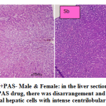 Figure 5a and b: ETH+PAS- Male & Female: in the liver section of the rats intoxicated with ETH+PAS drug, there was disarrangement and degeneration of normal hepatic cells with intense centrilobular necrosis.