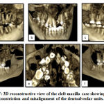 Figure 1: A-F: 3D reconstructive view of the cleft maxilla case showing severe arch constriction and misalignment of the dentoalveolar units.