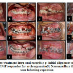Figure 2: a-d: pre-treatment intra oral records e-g: initial alignment stage with HANT wire, 3h; use of NiTi expander for arch expansion3l, Nasomaxillary fistula formation seen following expansion