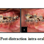 Figure 6: a-d, Post-distraction intra-oral photographs