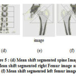 Figure 5: (d) Mean shift segmented spine Image, (e) Mean shift segmented right Femur image and (f) Mean shift segmented left femur image.