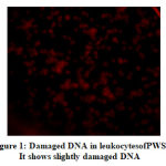 Figure 1:Damaged DNA in leukocytesofPWS. It shows slightly damaged DNA