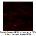 Figure 2: Damaged DNA in leukocytes in PWS. It shows a severely damaged DNA