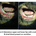 Figure 4: Edematous upper and lower lips with crusting & dried blood present on vermilion.