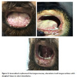 Figure 6: Generalized erythema of the tongue mucosa, ulcerations in all tongue surfaces with sloughed tissue on ulcers boundaries.