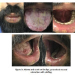 Figure 9: Adema and crust on the lips, generalized mucosal ulceration with sluffing.