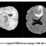 Figure 1: original MRI brain images with the tumor