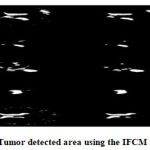 Figure 3: Tumor detected area using the IFCM algorithm.