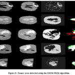 Figure 8: Tumor area detected using the ISOM-FKM algorithm.