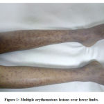 Figure 1: Multiple erythematous lesions over lower limbs.