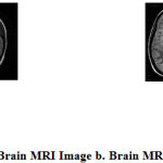 Figure 1: a. Normal Brain MRI Image b. Brain MRI Image with Tumor