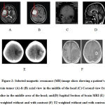 Figure 2: Selected magnetic resonance (MR) image slices showing a patient’s brain tumor (A) & (B) axial view in the middle of the head (C) Coronal view from a slice in the middle area of the head; and(D) Sagittal Section of brain MRI (E) T1 weighted without and with contrast (F) T2 weighted without and with contrast
