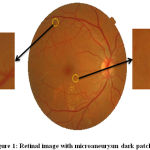 Figure 1: Retinal image with microaneurysm dark patches