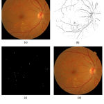 Figure 4: Microaneurysms detection in retinal image: step wise results