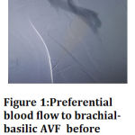 Figure 1:Preferential blood flow to brachial-basilic AVF before plication of basilic vein