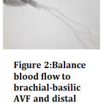 Figure 2:Balance blood flow to brachial-basilic AVF and distal artery after plication of basilic vein