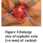 Figure 3: Enlarge size of cephalic vein (>6 mm) of rachial-cephalic AVF