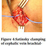 Figure 4: Satinsky clamping of cephalic vein brachial-cephalic AVF