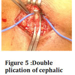 Figure 5 :Double plication of cephalic vein of brachial-cephalic AVF