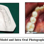 Figure 2a: Study Model and Intra Oral Photograph at T0