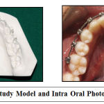 Figure 2b: Study Model and Intra Oral Photograph at T1