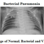 Figure 1: X-ray image of Normal. Bacterial and Viral pneumonia patient
