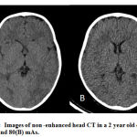 Figure 2: Images of non -enhanced head CT in a 2 year old child at 250 (A) and 80(B) mAs.