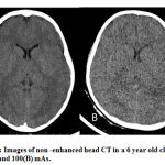 Figure 3: Images of non -enhanced head CT in a 6 year old child at 250 (A) and 100(B) mAs.