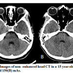 Figure 4: Images of non -enhanced head CT in a 15 year old child at 250 (A) and 150(B) mAs.