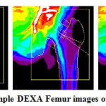 Figure 2: Sample DEXA Femur images of 5 subjects